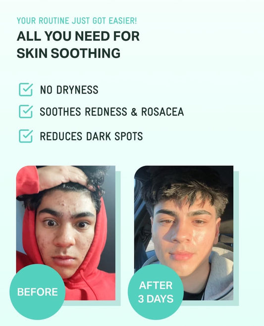 Bring Green Zinc Teca Blemish Serum 25 ml + Squid Game Gonggi! 2 Pack- Rare!